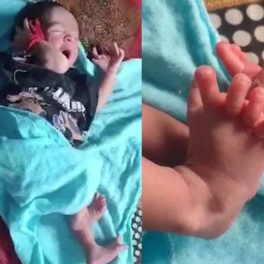 Μωράκι γεννήθηκε με 26 δάχτυλα 
